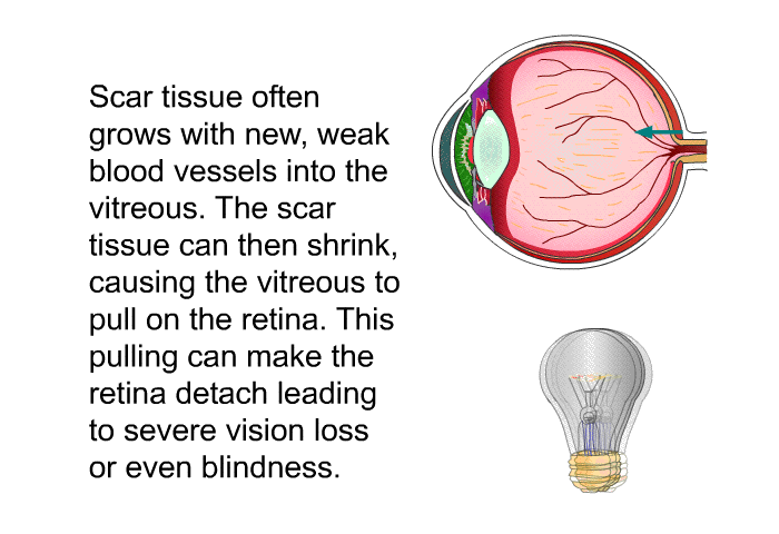 Scar tissue often grows with new, weak blood vessels into the vitreous. The scar tissue can then shrink, causing the vitreous to pull on the retina. This pulling can make the retina detach leading to severe vision loss or even blindness.