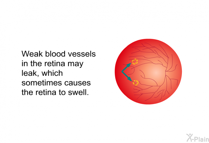 Weak blood vessels in the retina may leak, which sometimes causes the retina to swell.