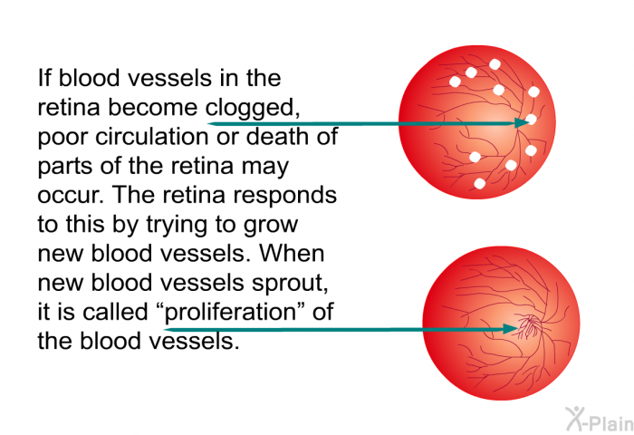If blood vessels in the retina become clogged, poor circulation or death of parts of the retina may occur. The retina responds to this by trying to grow new blood vessels. When new blood vessels sprout, it is called “proliferation” of the blood vessels.