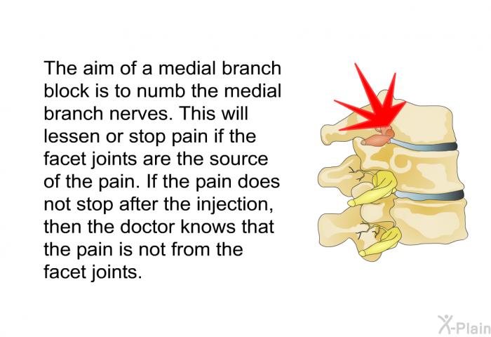 The aim of a medial branch block is to numb the medial branch nerves. This will lessen or stop pain if the facet joints are the source of the pain. If the pain does not stop after the injection, then the doctor knows that the pain is not from the facet joints.