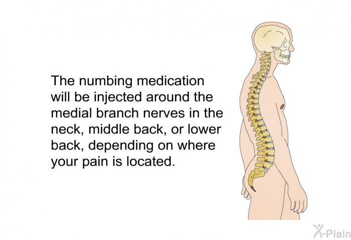 The numbing medication will be injected around the medial branch nerves in the neck, middle back, or lower back, depending on where your pain is located.