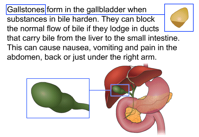 Gallstones form in the gallbladder when substances in bile harden. They can block the normal flow of bile if they lodge in ducts that carry bile from the liver to the small intestine. This can cause nausea, vomiting and pain in the abdomen, back or just under the right arm.