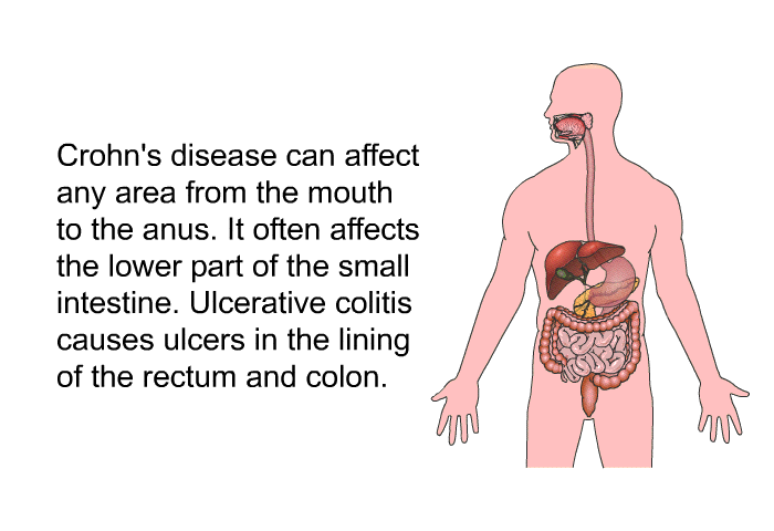 Crohn's disease can affect any area from the mouth to the anus. It often affects the lower part of the small intestine. Ulcerative colitis causes ulcers in the lining of the rectum and colon.