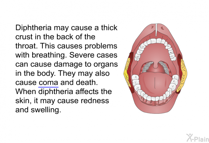 Diphtheria may cause a thick crust in the back of the throat. This causes problems with breathing. Severe cases can cause damage to organs in the body. They may also cause coma and death. When diphtheria affects the skin, it may cause redness and swelling.
