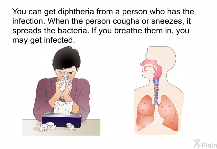 You can get diphtheria from a person who has the infection. When the person coughs or sneezes, it spreads the bacteria. If you breathe them in, you may get infected.
