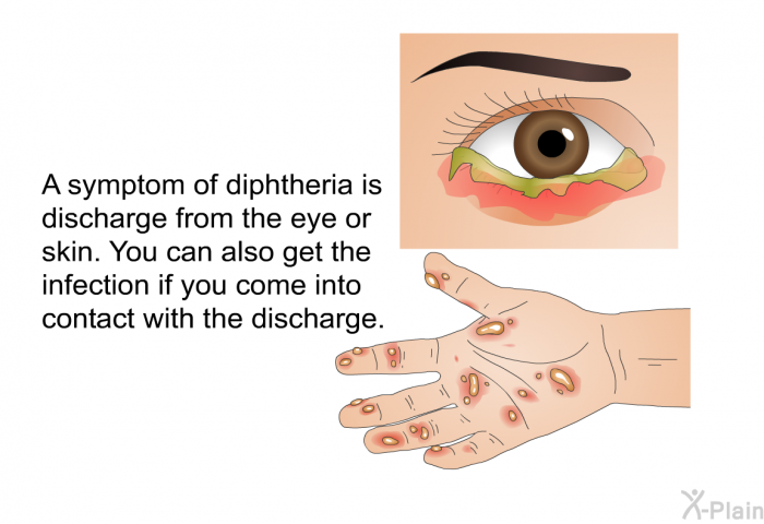 A symptom of diphtheria is discharge from the eye or skin. You can also get the infection if you come into contact with the discharge.