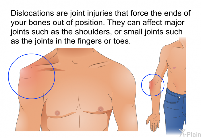 Dislocations are joint injuries that force the ends of your bones out of position. They can affect major joints such as the shoulders, or small joints such as the joints in the fingers or toes.