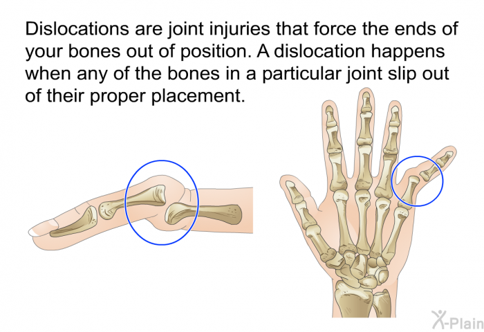 Dislocations are joint injuries that force the ends of your bones out of position. A dislocation happens when any of the bones in a particular joint slip out of their proper placement.
