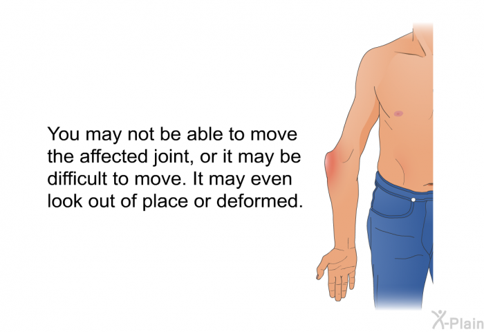 You may not be able to move the affected joint, or it may be difficult to move. It may even look out of place or deformed.