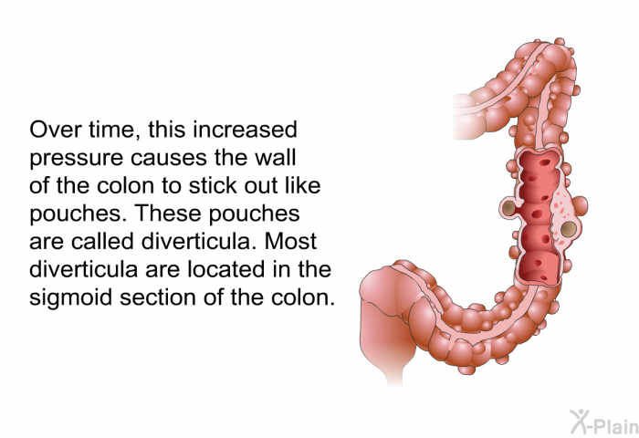 Over time, this increased pressure causes the wall of the colon to stick out like pouches. These pouches are called diverticula. Most diverticula are located in the sigmoid section of the colon.