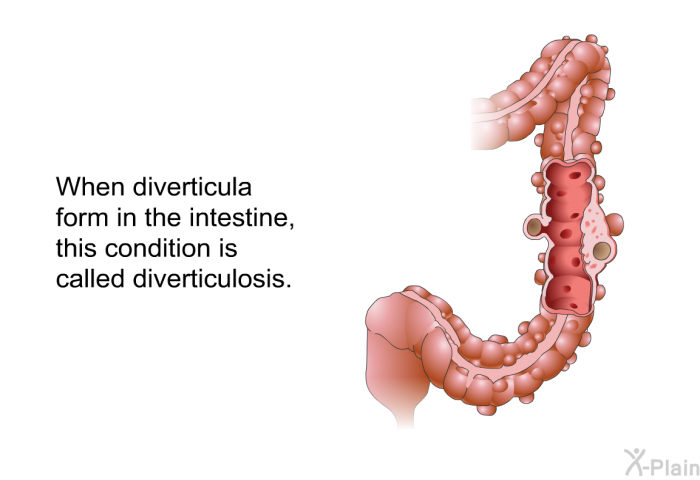 When diverticula form in the intestine, this condition is called diverticulosis.