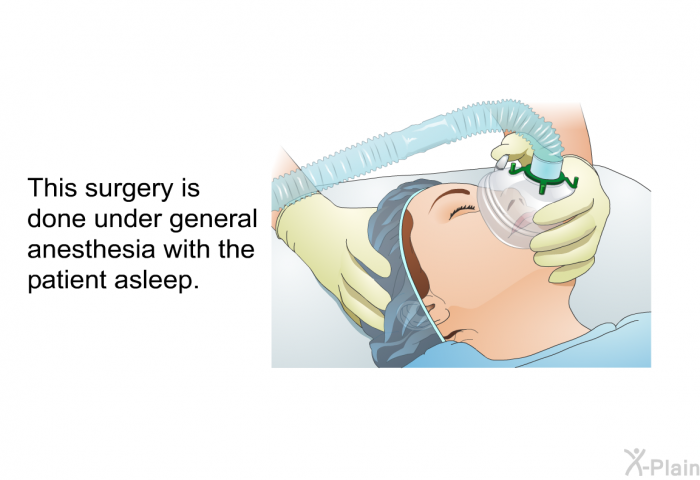 This surgery is done under general anesthesia with the patient asleep.
