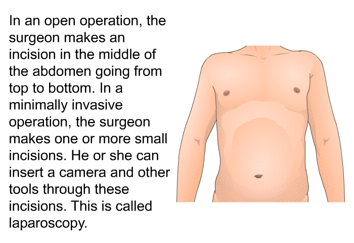 In an open operation, the surgeon makes an incision in the middle of the abdomen going from top to bottom. In a minimally invasive operation, the surgeon makes one or more small incisions. He or she can insert a camera and other tools through these incisions. This is called laparoscopy.