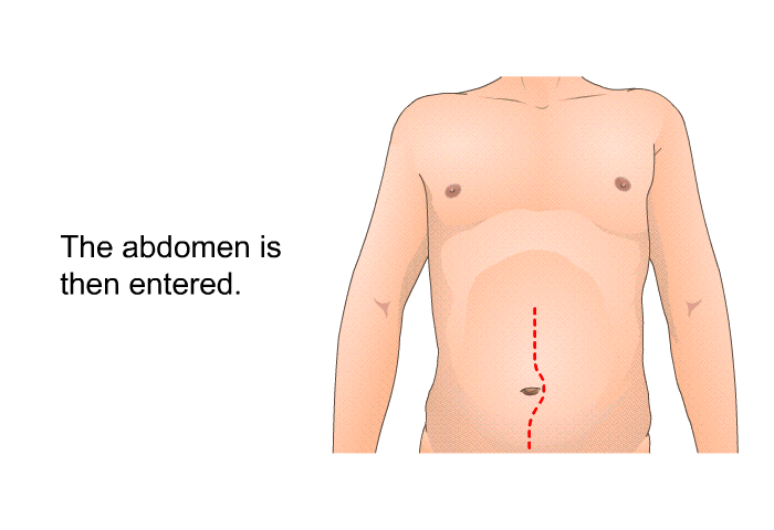The abdomen is then entered.