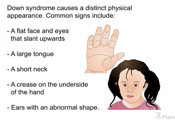Down syndrome causes a distinct physical appearance. Common signs include:  A flat face and eyes that slant upwards A large tongue A short neck A crease on the underside of the hand Ears with an abnormal shape.