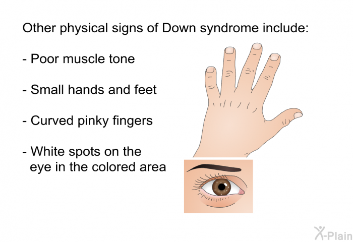 Other physical signs of Down syndrome include:  Poor muscle tone Small hands and feet Curved pinky fingers White spots on the eye in the colored area