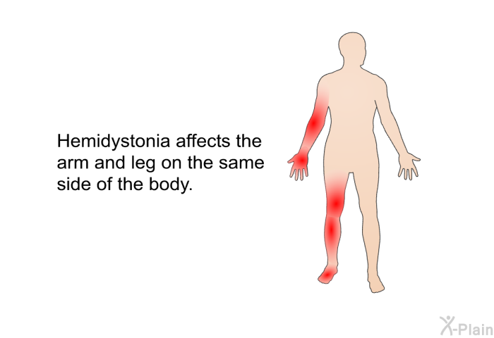 Hemidystonia affects the arm and leg on the same side of the body.