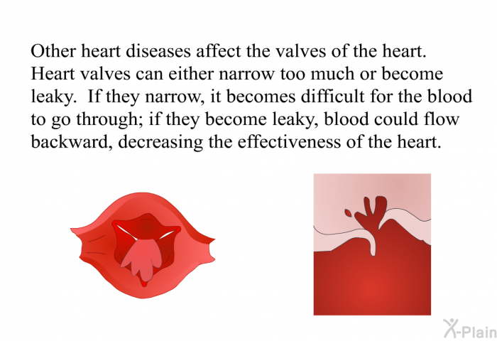 Other heart diseases affect the valves of the heart. Heart valves can either narrow too much or become leaky. If they narrow, it becomes difficult for the blood to go through; if they become leaky, blood could flow backward, decreasing the effectiveness of the heart.