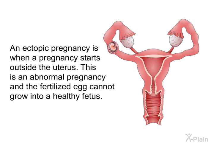 An ectopic pregnancy is when a pregnancy starts outside the uterus. This is an abnormal pregnancy and the fertilized egg cannot grow into a healthy fetus.