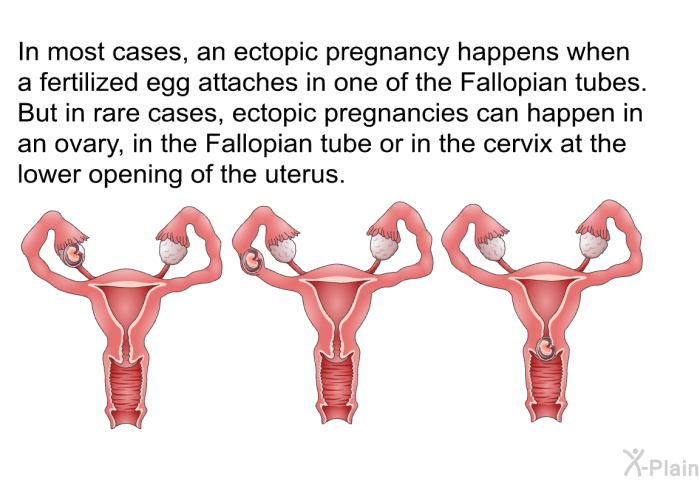 In most cases, an ectopic pregnancy happens when a fertilized egg attaches in one of the Fallopian tubes. But in rare cases, ectopic pregnancies can happen in an ovary, in the Fallopian tube or in the cervix at the lower opening of the uterus.