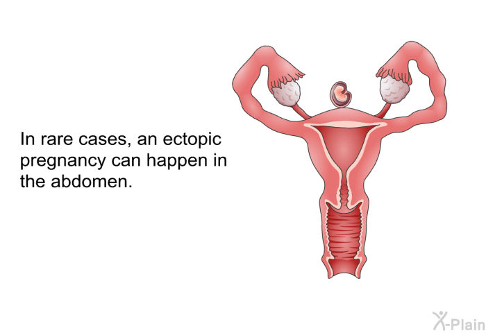 In rare cases, an ectopic pregnancy can happen in the abdomen.