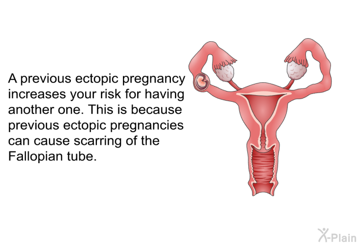 A previous ectopic pregnancy increases your risk for having another one. This is because previous ectopic pregnancies can cause scarring of the Fallopian tube.