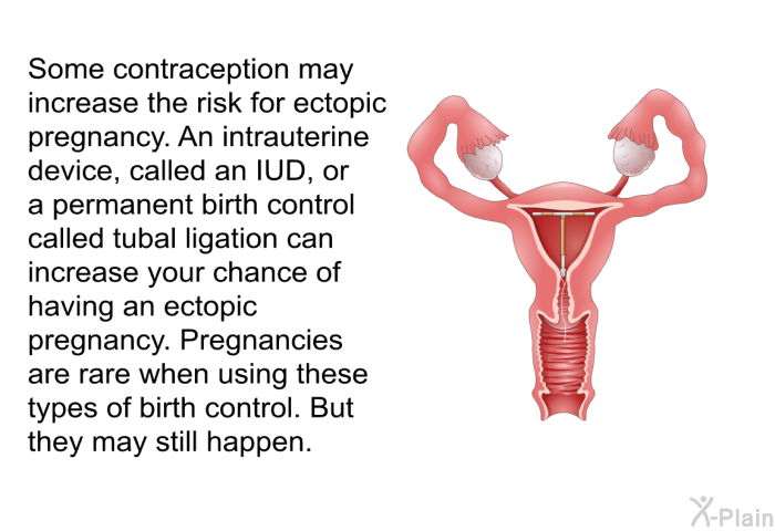 Some contraception may increase the risk for ectopic pregnancy. An intrauterine device, called an IUD, or a permanent birth control called tubal ligation can increase your chance of having an ectopic pregnancy. Pregnancies are rare when using these types of birth control. But they may still happen.