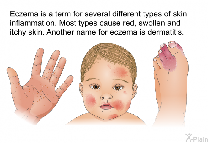 Eczema is a term for several different types of skin inflammation. Most types cause red, swollen and itchy skin. Another name for eczema is dermatitis.