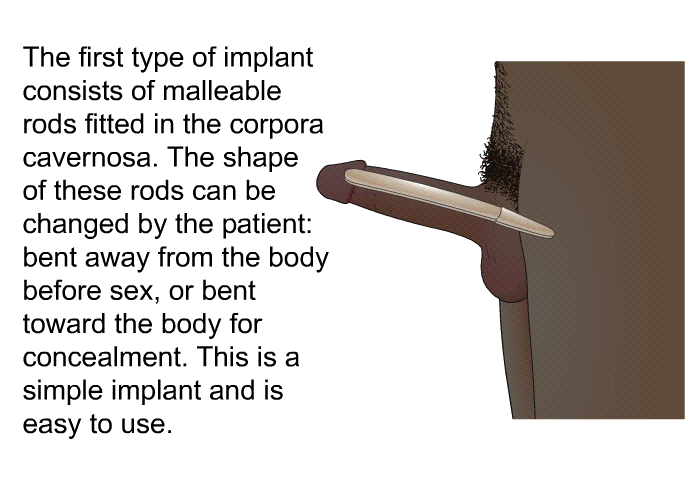 The first type of implant consists of malleable rods fitted in the corpora cavernosa. The shape of these rods can be changed by the patient: bent away from the body before sex, or bent toward the body for concealment. This is a simple implant and is easy to use.