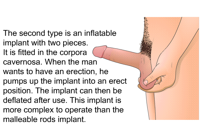 The second type is an inflatable implant with two pieces. It is fitted in the corpora cavernosa. When the man wants to have an erection, he pumps up the implant into an erect position. The implant can then be deflated after use. This implant is more complex to operate than the malleable rods implant.