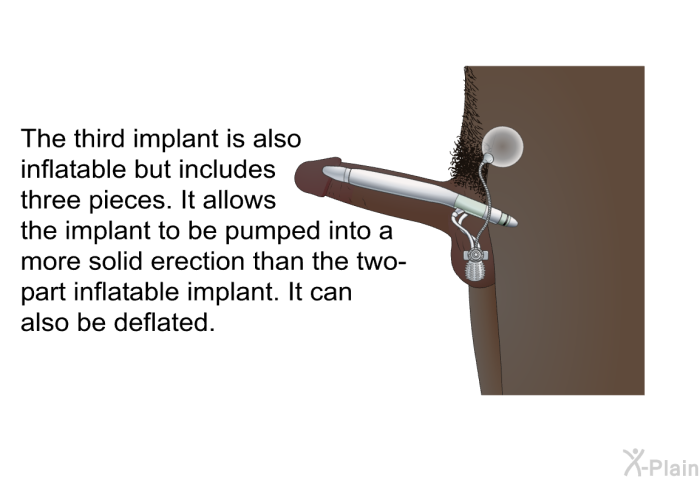 The third implant is also inflatable but includes three pieces. It allows the implant to be pumped into a more solid erection than the two-part inflatable implant. It can also be deflated.