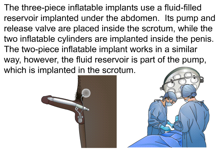 The three-piece inflatable implants use a fluid-filled reservoir implanted under the abdomen. Its pump and release valve are placed inside the scrotum, while the two inflatable cylinders are implanted inside the penis. The two-piece inflatable implant works in a similar way, however, the fluid reservoir is part of the pump, which is implanted in the scrotum.