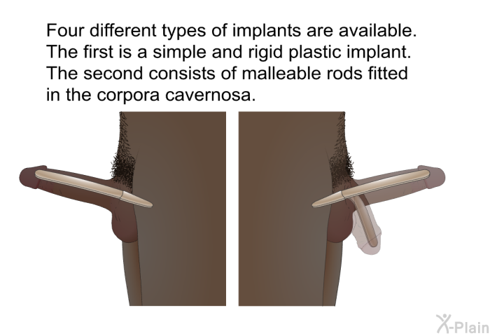 Four different types of implants are available. The first is a simple and rigid plastic implant. The second consists of malleable rods fitted in the corpora cavernosa.