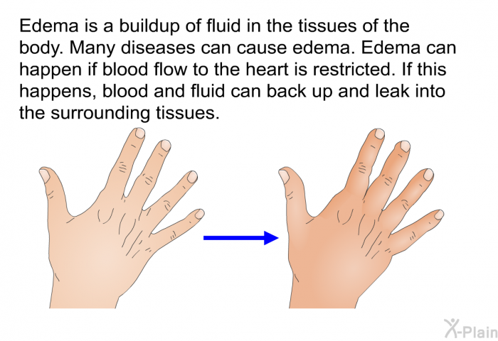 Edema is a buildup of fluid in the tissues of the body. Many diseases can cause edema. Edema can happen if blood flow to the heart is restricted. If this happens, blood and fluid can back up and leak into the surrounding tissues.