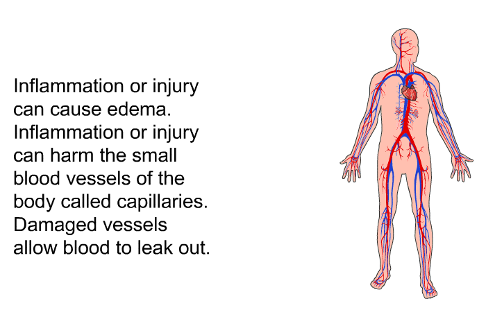 Inflammation or injury can cause edema. Inflammation or injury can harm the small blood vessels of the body called capillaries. Damaged vessels allow blood to leak out.