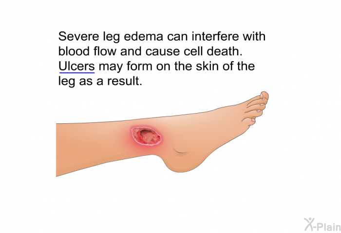Severe leg edema can interfere with blood flow and cause cell death. Ulcers may form on the skin of the leg as a result.