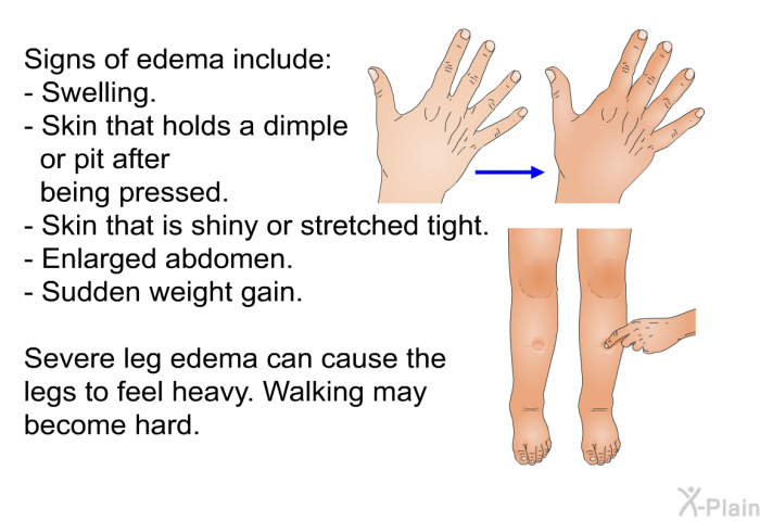 Signs of edema include:  Swelling. Skin that holds a dimple or pit after being pressed. Skin that is shiny or stretched tight. Enlarged abdomen. Sudden weight gain.  
 Severe leg edema can cause the legs to feel heavy. Walking may become hard.