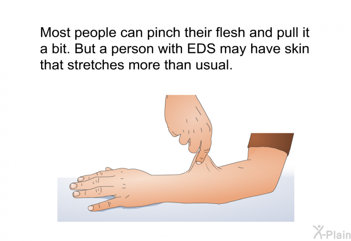 Most people can pinch their flesh and pull it a bit. But a person with EDS may have skin that stretches more than usual.