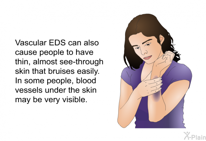 Vascular EDS can also cause people to have thin, almost see-through skin that bruises easily. In some people, blood vessels under the skin may be very visible.