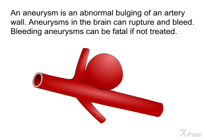 An aneurysm is an abnormal bulging of an artery wall. Aneurysms in the brain can rupture and bleed. Bleeding aneurysms can be fatal if not treated.
