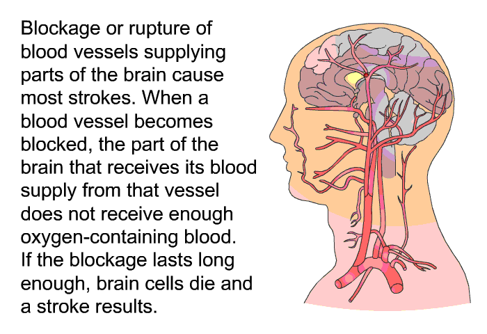 Blockage or rupture of blood vessels supplying parts of the brain cause most strokes. When a blood vessel becomes blocked, the part of the brain that receives its blood supply from that vessel does not receive enough oxygen-containing blood. If the blockage lasts long enough, brain cells die and a stroke results.