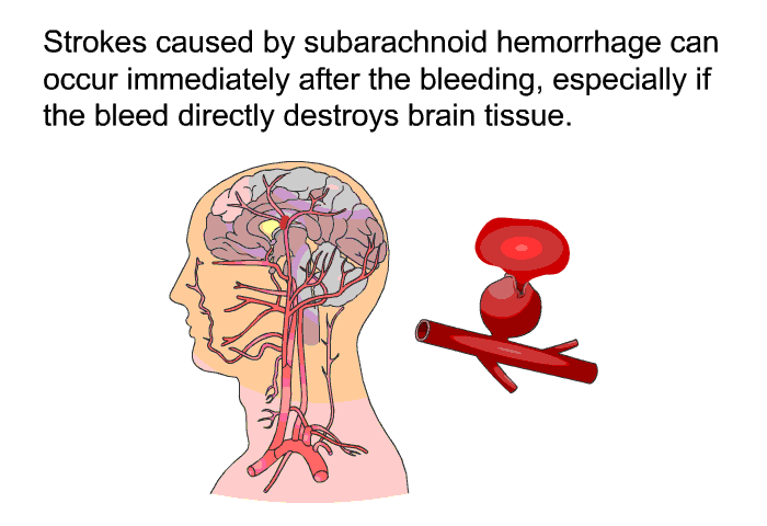 Strokes caused by subarachnoid hemorrhage can occur immediately after the bleeding, especially if the bleed directly destroys brain tissue.