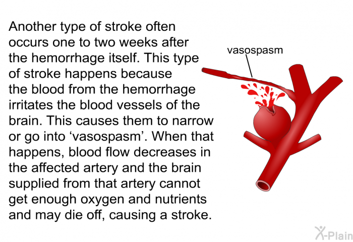 Another type of stroke often occurs one to two weeks after the hemorrhage itself. This type of stroke happens because the blood from the hemorrhage irritates the blood vessels of the brain. This causes them to narrow or go into  vasospasm'. When that happens, blood flow decreases in the affected artery and the brain supplied from that artery cannot get enough oxygen and nutrients and may die off, causing a stroke.
