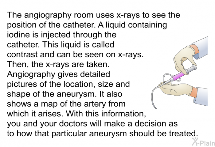 The angiography room uses x-rays to see the position of the catheter. A liquid containing iodine is injected through the catheter. This liquid is called contrast and can be seen on x-rays. Then, the x-rays are taken. 
 
Angiography gives detailed pictures of the location, size and shape of the aneurysm. It also shows a map of the artery from which it arises. With this information, you and your doctors will make a decision as to how that particular aneurysm should be treated.