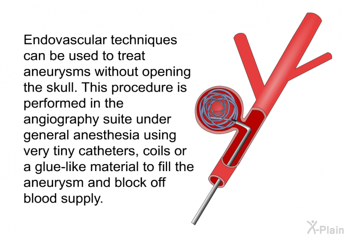 Endovascular techniques can be used to treat aneurysms without opening the skull. This procedure is performed in the angiography suite under general anesthesia using very tiny catheters, coils or a glue-like material to fill the aneurysm and block off blood supply.