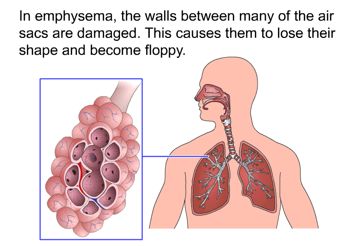 In emphysema, the walls between many of the air sacs are damaged. This causes them to lose their shape and become floppy.