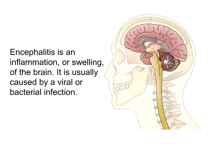 Encephalitis is an inflammation, or swelling, of the brain. It is usually caused by a viral or bacterial infection.