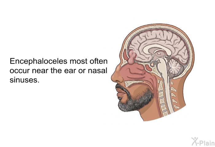 Encephaloceles most often occur near the ear or nasal sinuses.