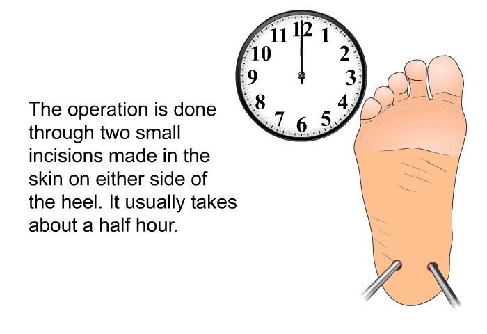 The operation is done through two small incisions made in the skin on either side of the heel. It usually takes about a half hour.