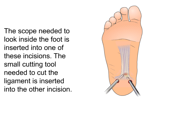 The scope needed to look inside the foot is inserted into one of these incisions. The small cutting tool needed to cut the ligament is inserted into the other incision.